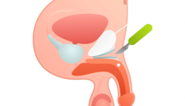 How does penis enlargement surgery work?